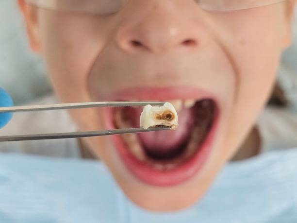 Best Emergency Wisdom Tooth Extraction in Montevideo, MN